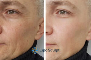 How to Fight Aging Symptoms 3 Fight Aging Symptoms Shropshire With HIFU and Morpheus8 Today!