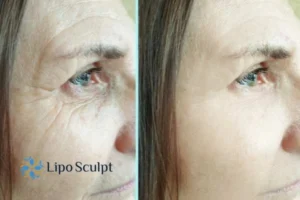 How to Fight Aging Symptoms 2 Do you want to Fight Aging Symptoms Shropshire? Contact Lipo Sculpt today!
